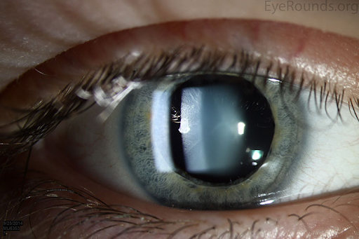 Normal crystalline lens